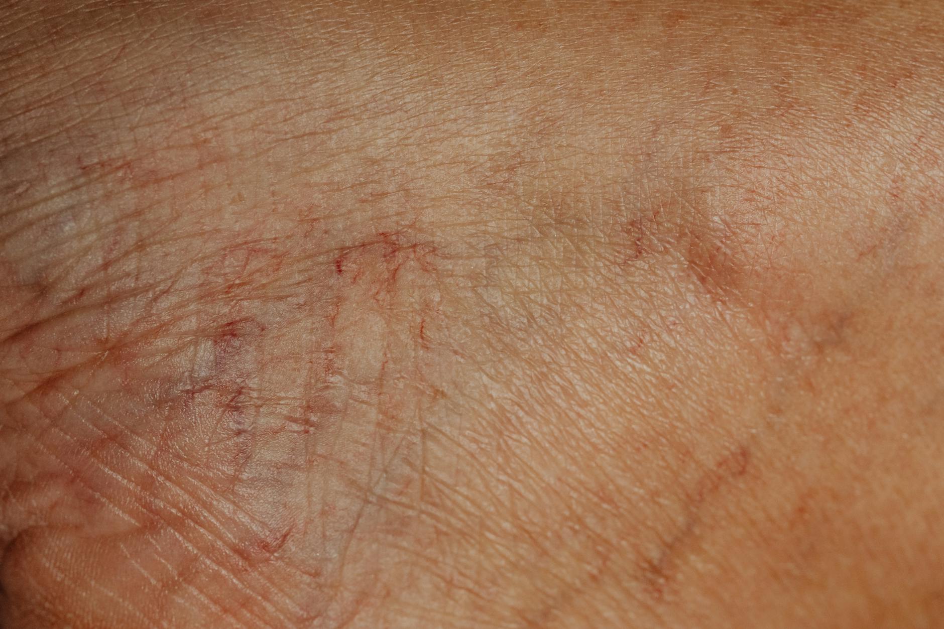 Detailansicht: Hautauschlag Nierenprobleme